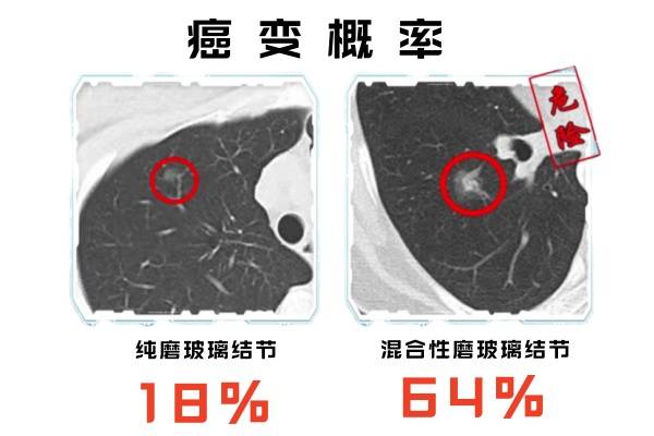 磨玻璃結節癌變的概率有多大?預防勝於治療_發展_肺部