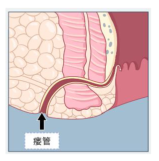 肛瘘延伸到阴囊图片图片