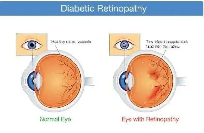 neuroretinopathy图片