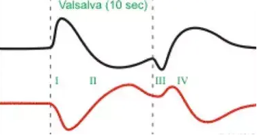 valsalva动作图示法图片