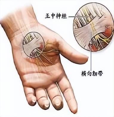 腕管综合症检查示图图片