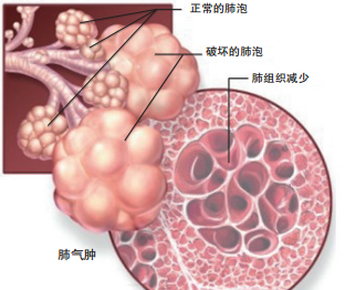 冬季慢性支气管炎如何做好预防和调理?_患者_发展