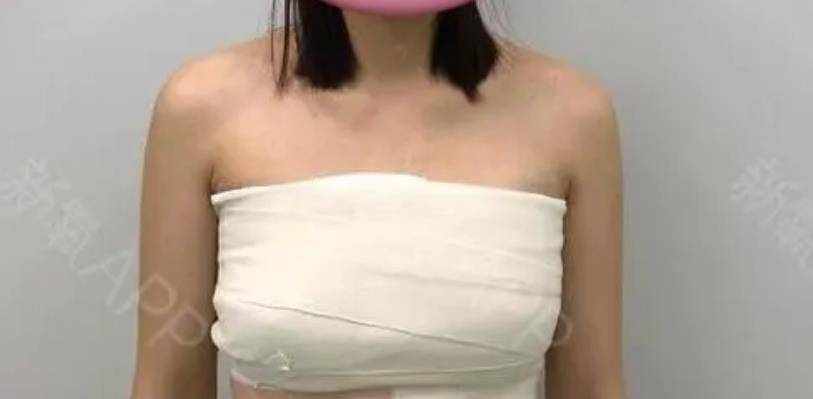 自体脂肪丰胸经历亲身:听听过来人自体脂肪隆胸忠告