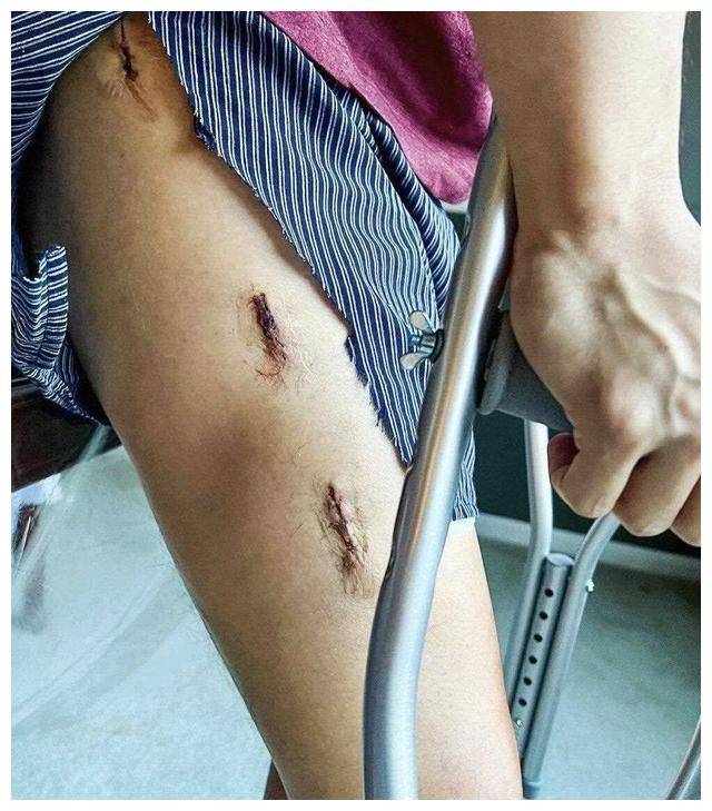 手术后大腿惊现缝合伤口,惊人一幕震撼!