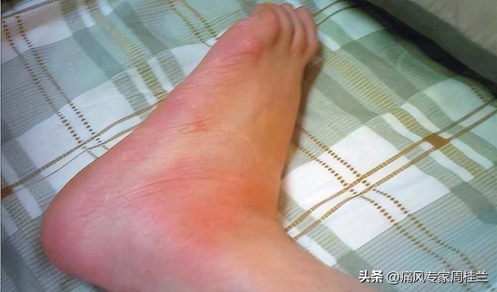 痛风吃维生素b2,有什么好处?几块钱的维生素b2能天天?