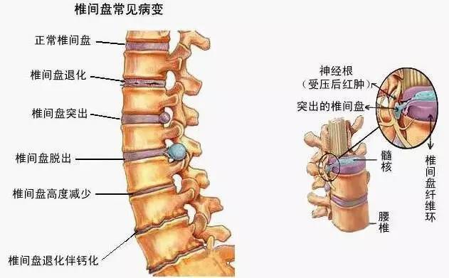 腰椎间盘突出疼痛点图图片