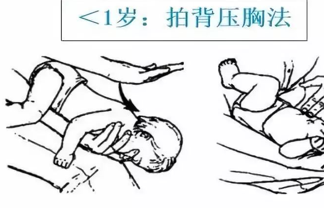 注意事项 5次拍背法5次压胸法循环直至异物排出;操作时随时观察口中