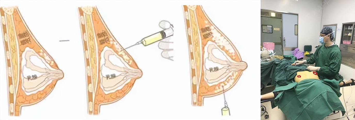 丰体针丰胸注射方法图片