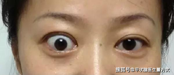 甲状腺疾病朋友要注意,眼睛出现这5种情况,需警惕突眼