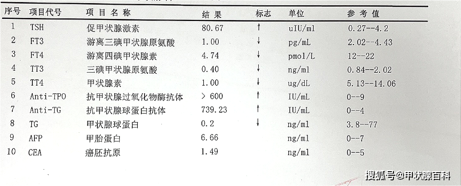 武漢甲康醫院陳曉華醫生科普:得橋本甲狀腺炎超過5年8