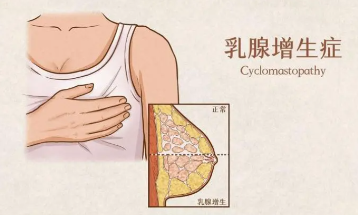 乳腺结节三级怎么控制?_女性_治疗_患者