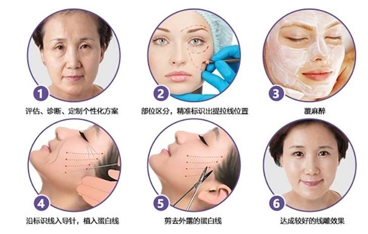 疑问线雕面部提升能保持多长时间,埋线提升面部可以维持多久?