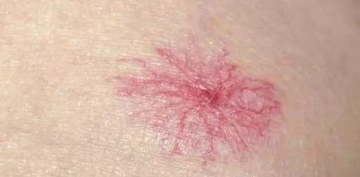 2个肝硬化"前兆"早知道,跨过肝脏"寿命坎",健康更长久!