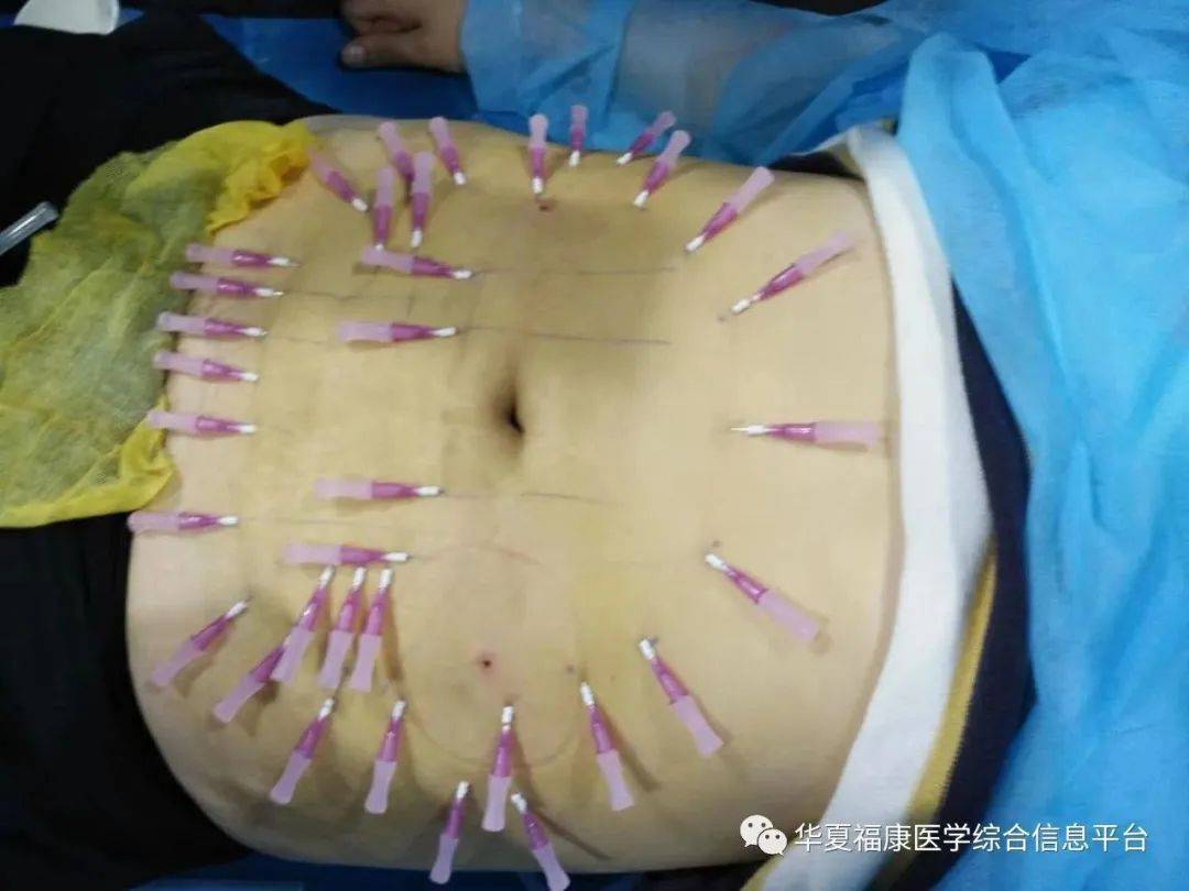 顾春英全国中医诊疗局部雕塑美容减肥,无痕线雕提升术精品班