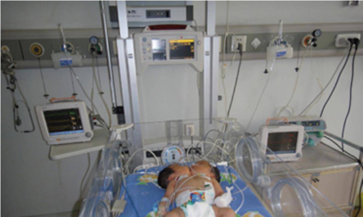 2011年,四川孕妇生下中国第一例"双头女婴",最后怎样了?