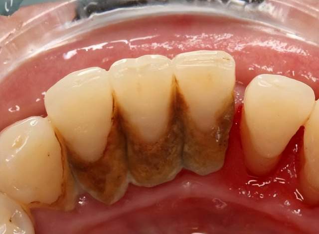 牙结石发黄发臭怎么办?过招一定不能错过,学会轻松刷掉牙石!