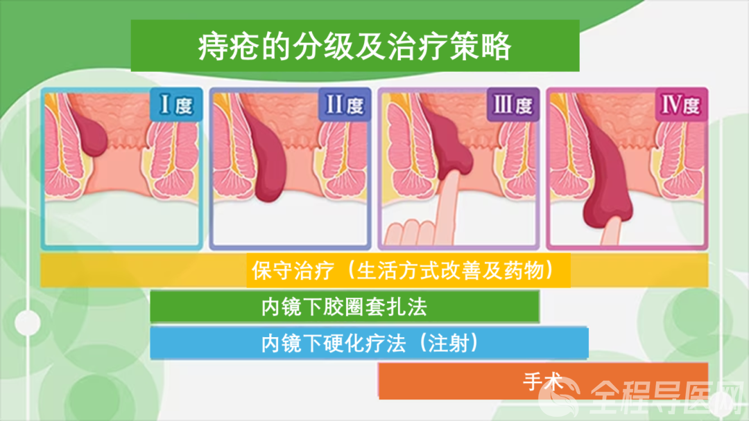 痔疮图片怎么治疗图片