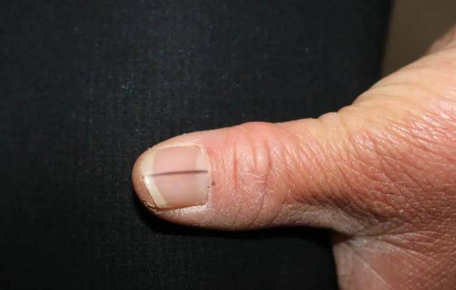 暗示体内有毒素寄存,中医认为指甲依赖于肝血和肝气的荣养,因此黑色竖