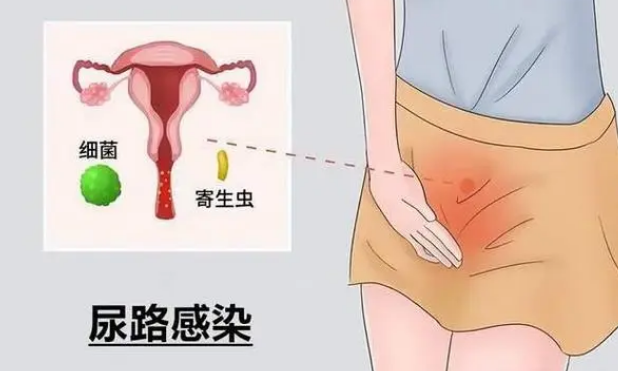 女性尿道感染起因图片