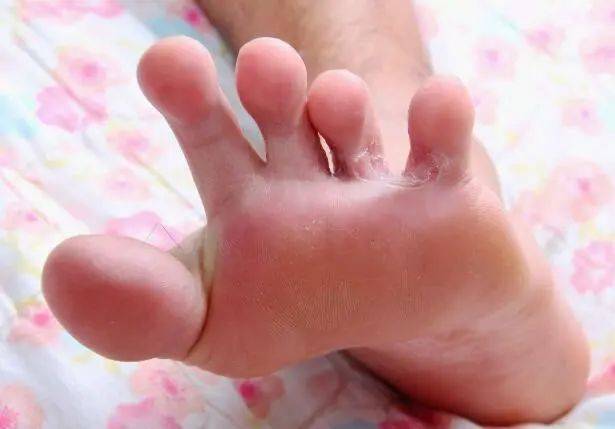 血糖高不高,看看脚就知道,这六种变化,提醒你该降糖了!