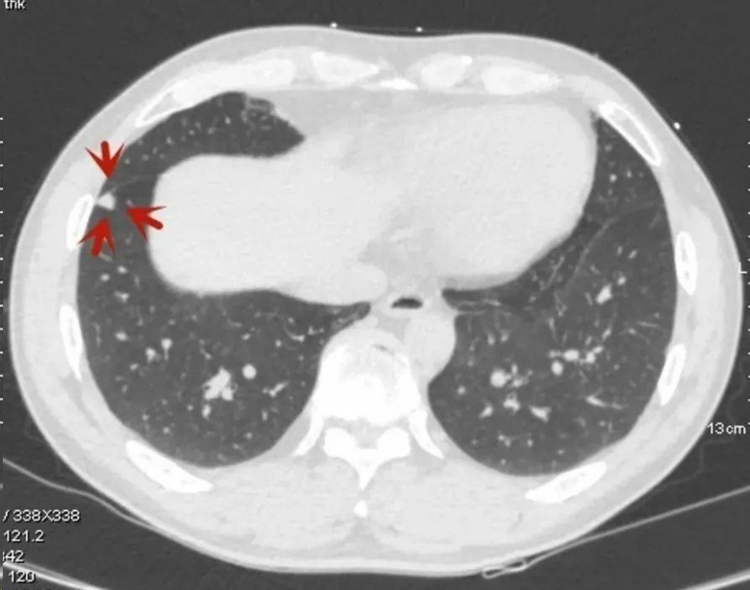 实性结节的良恶性主要影像鉴别征象:肺癌病例有分叶,毛刺及胸膜蝶形