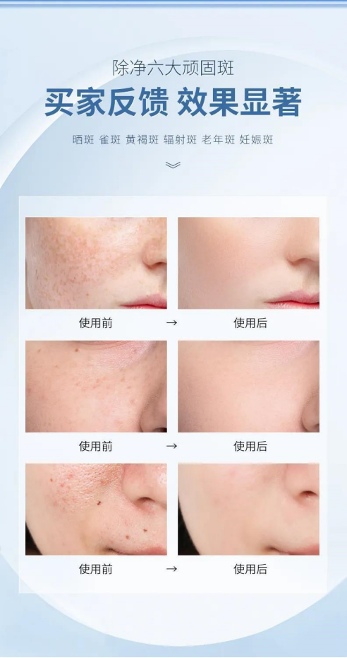 有斑用什么护肤品好,美白攻略分享_肌肤_成分_兰蔻