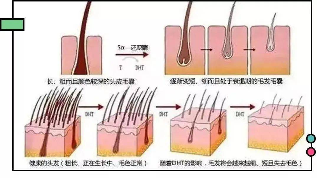 雄激素性脱发原理图片