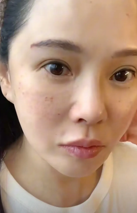 原创秦昊老婆跑韩国打水光针56岁伊能静满脸针眼直言痛得值得