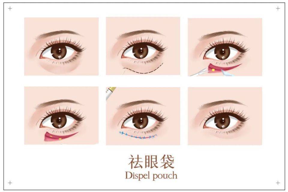 多久能好?做眼袋手术多长时间能恢复,做眼袋多久能恢复?