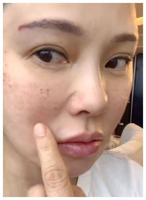 秦昊老婆飞韩国打水光针,56岁伊能静针眼满脸,感叹疼痛难忍.