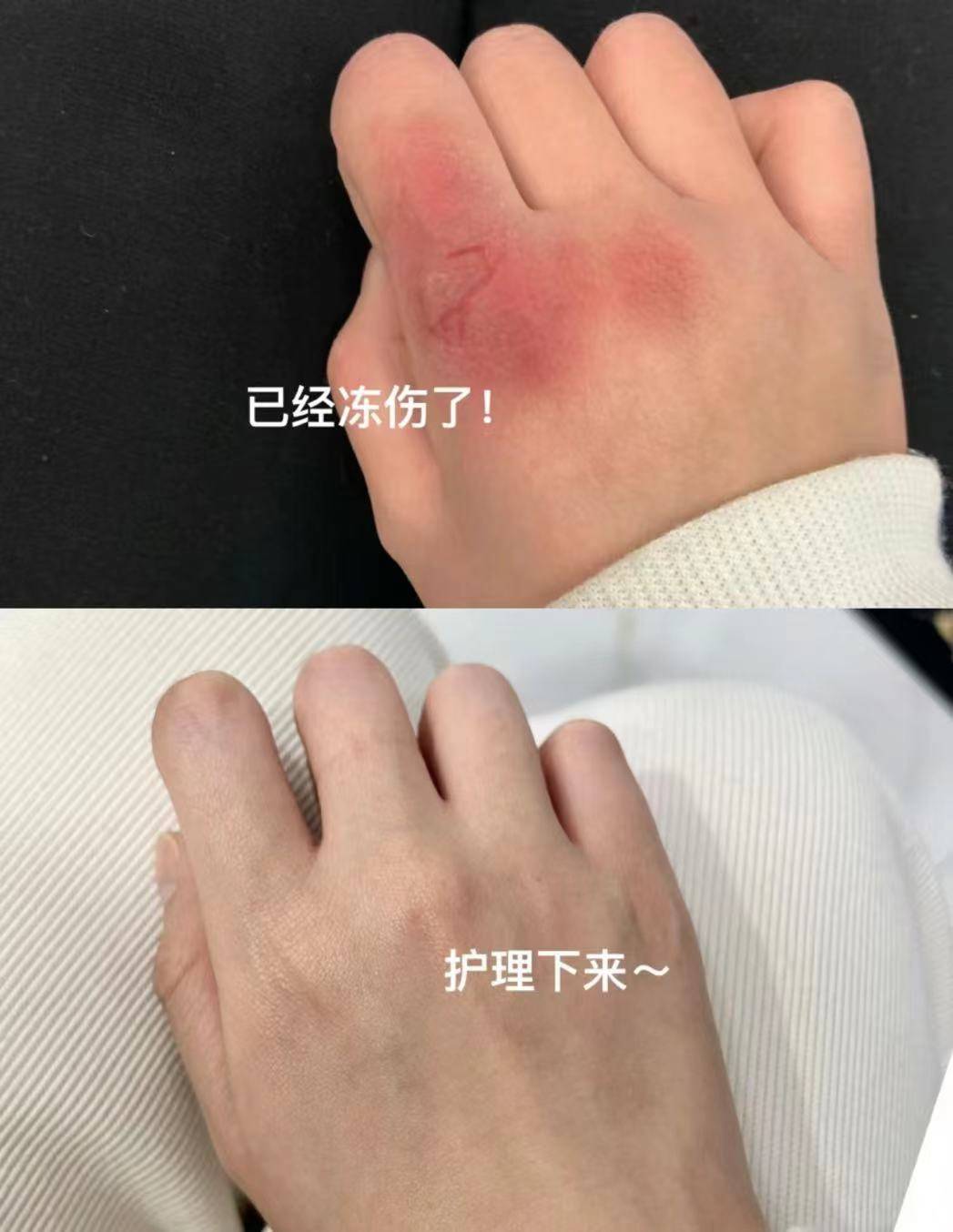 治好冻疮才花200块钱这个方法实在太厉害短效除根还不反