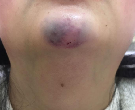 对于外形影响不大的生长因子,卢教授不建议取出!_进行_细胞_药物