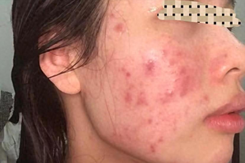 过来人公认好用的祛痘印产品平均每天几毛钱28天告别红黑痘印