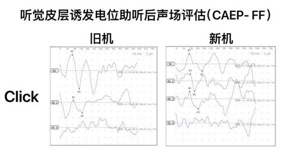 乐至惠耳助听器验配中心分享:九岁小朋友佩戴神逸5300效果如何?