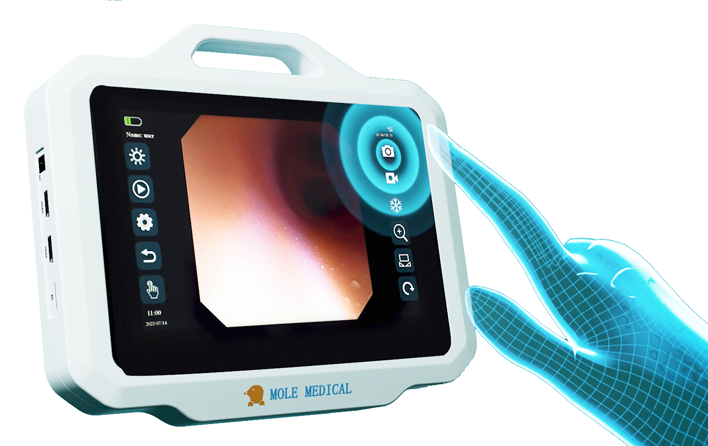 电子支气管镜-麻醉医生的"第三只眼"_患者_气道_技术