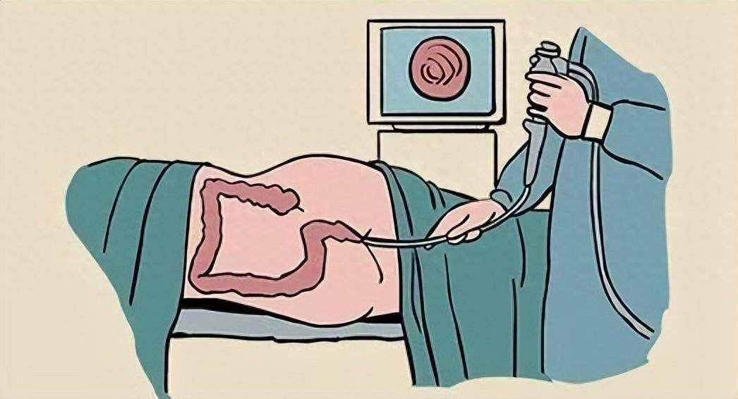 80%以上的肠癌都是从肠息肉演变而来!这个检查一定要重视