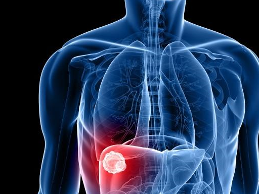 原创早期肝癌有哪些症状看完要留点心