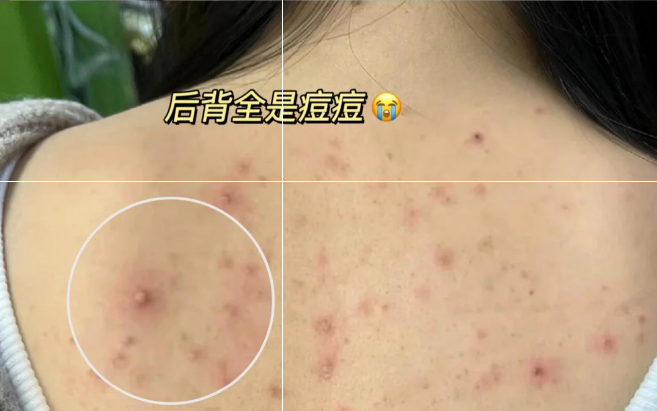 67后背螨虫痘痘1个月轻松去除!这三个方法是重点!看完终身受益!