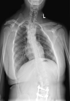 神经"听诊器"——高低肩患儿的术中电生理监测