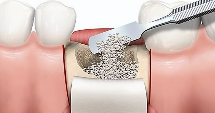 种植牙失败了怎么办?