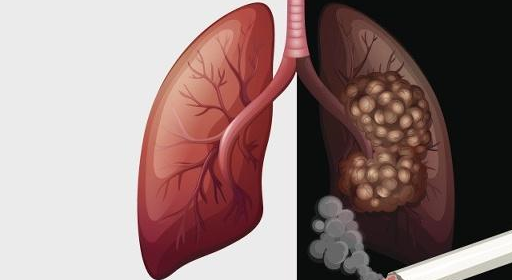 原創愛吸菸的人咳嗽時伴隨3個感覺可能是肺癌的敲門聲