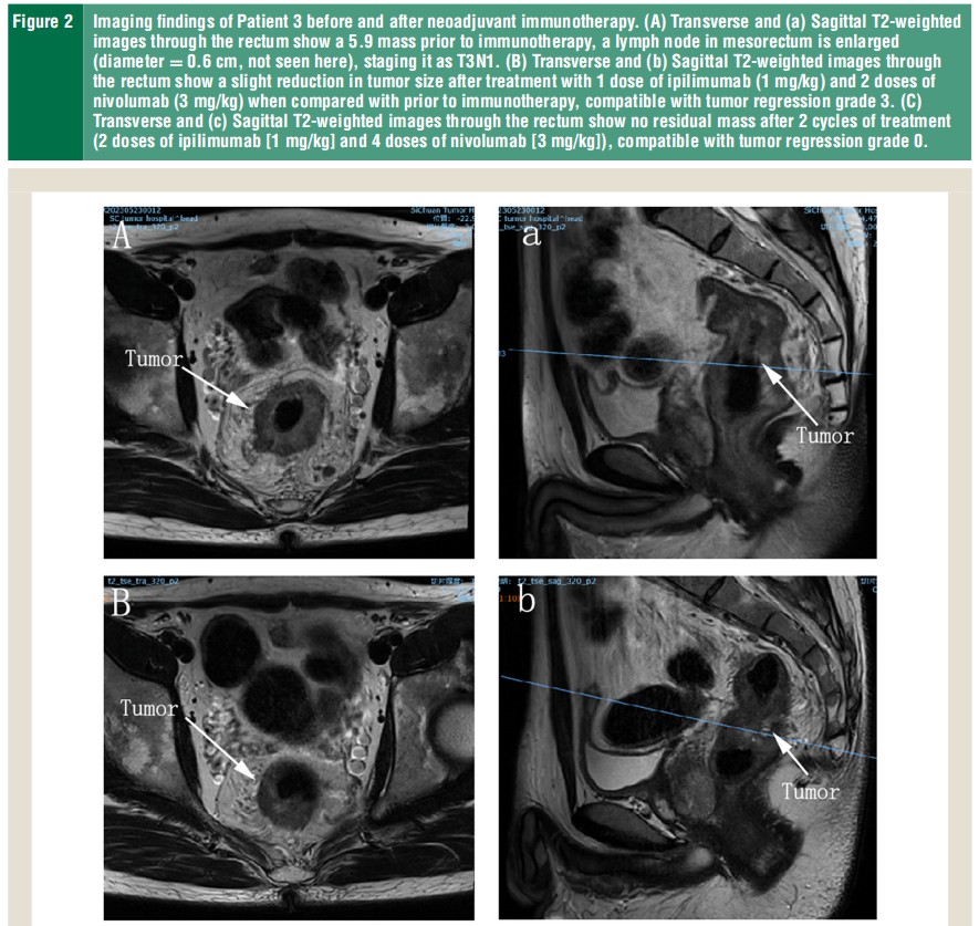 dmmrmsih晚期结直肠癌pcr达818新辅助伊匹木单抗纳武利尤单抗安全可行