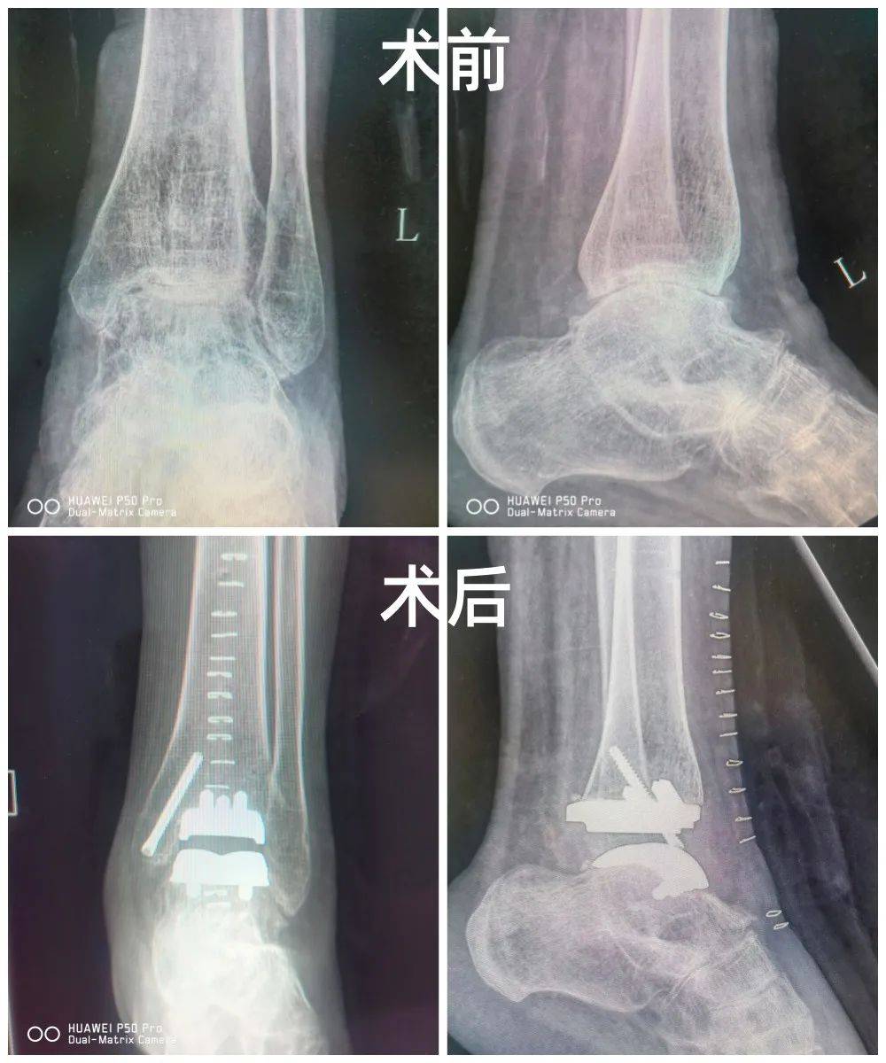 2024年,陈女士在我院成功地完成了左踝关节置换,因为左踝几乎长死且