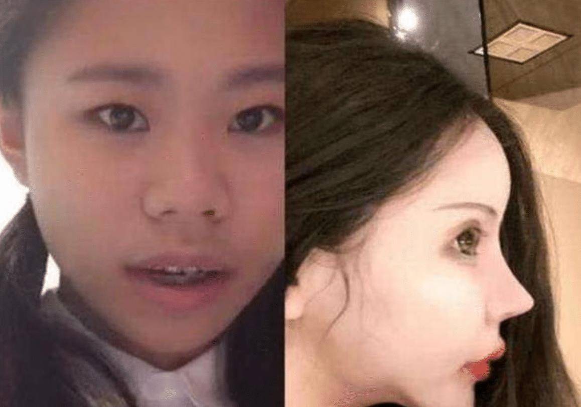 那位3年整形60次, 耗资近百万的网红女孩, 如今已判若两人_娜娜_外表