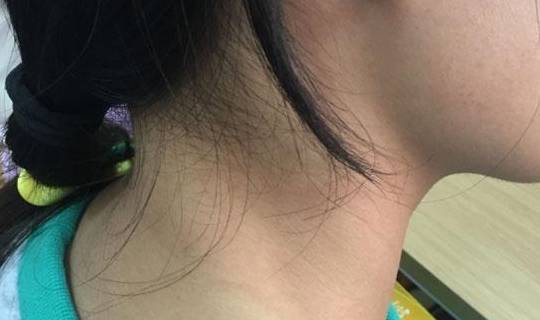 淋巴瘤早期静悄悄身体若出现这几种不适不要忽视了