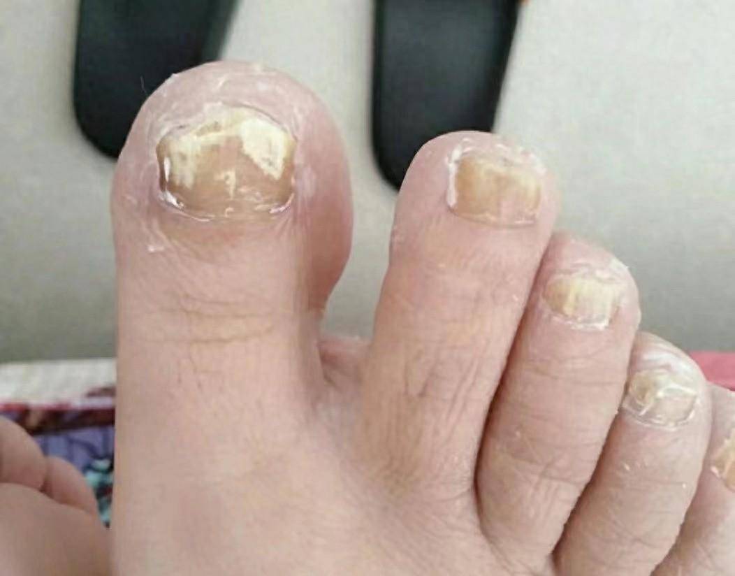 灰指甲必看的祛灰产品测评全是干货再不收藏就找不到了