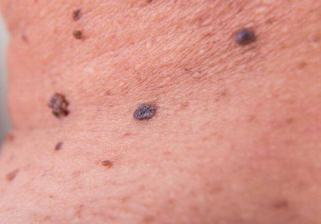 原创脖子和腋下的小肉粒是什么能直接用手揪掉吗看完请记牢