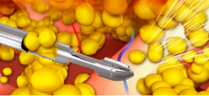 解析谜团脂肪胶填充是永久的吗脂肪胶需要二次填充嘛