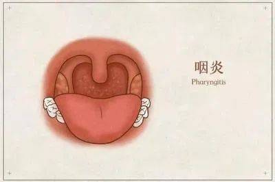 喉咙发炎吞咽口水都疼图片