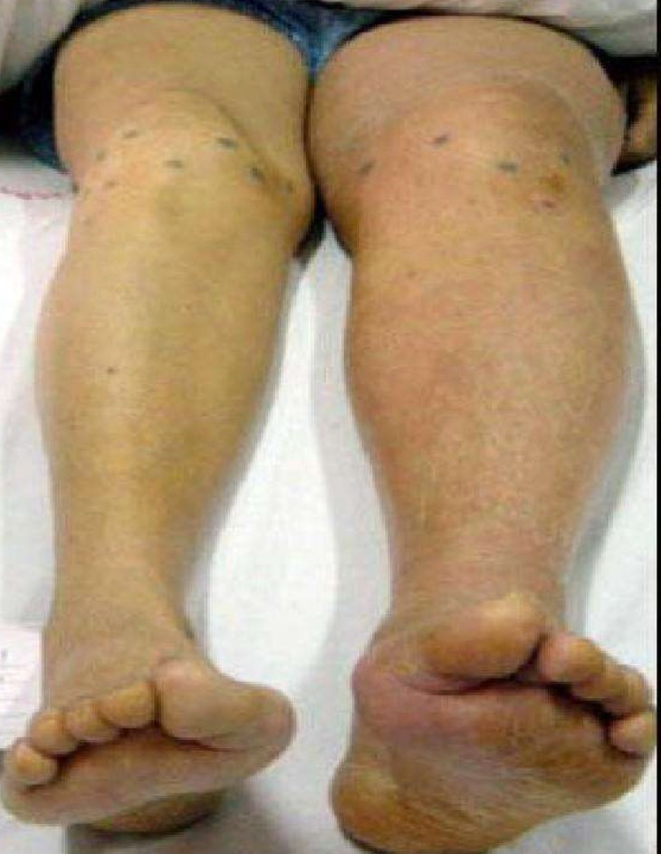 夏小雨医生:下肢深静脉血栓预防及护理方法